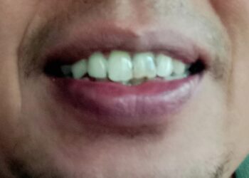 Ingin Gigi Putih Bersinar, Simak Tipe Alami Berikut ini 