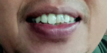 Ingin Gigi Putih Bersinar, Simak Tipe Alami Berikut ini 