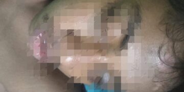 Korban Penganiayaan Dipulangkan Dari Rumah Sakit karena Tak Mampu Bayar Biaya Perawatan